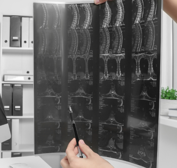 SCOLIOSIS 101: Understanding the Condition and Managing It with Physical Therapy and Pilates